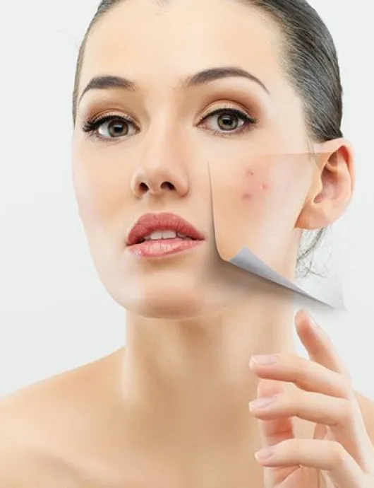 Điều trị da mụn